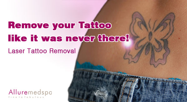 Safe, Affordable and Pain Free Laser Tattoo Removal at Allure medspa ...