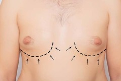 gynecomastia