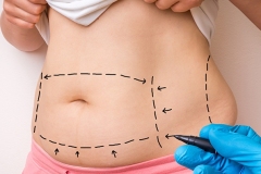 tummy-tuck