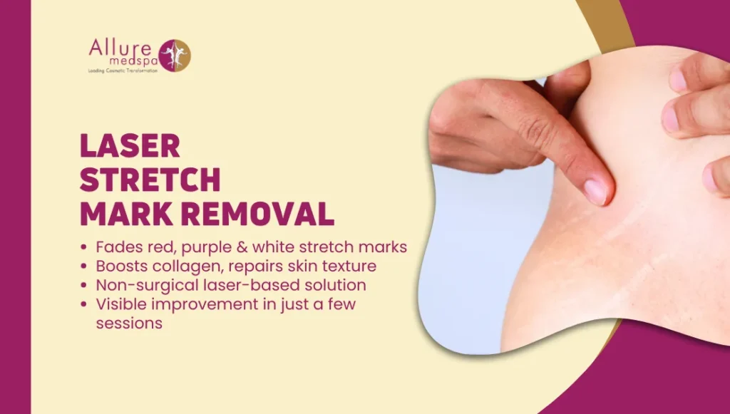 Best Laser Stretch Mark Removal Treatment in Mumbai