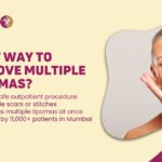 Best Way to remove multiple lipoma in Mumbai