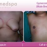 Gynecomastia Surgery - Male Breast Reduction - Before & After Photos Mumbai, India