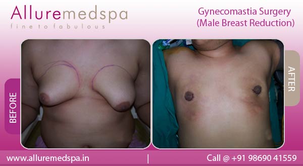 Gynecomastia Surgery - Male Breast Reduction - Before & After Photos Mumbai, India