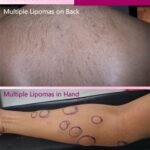 Multiple Lipomas Removal Surgery in Mumbai, India