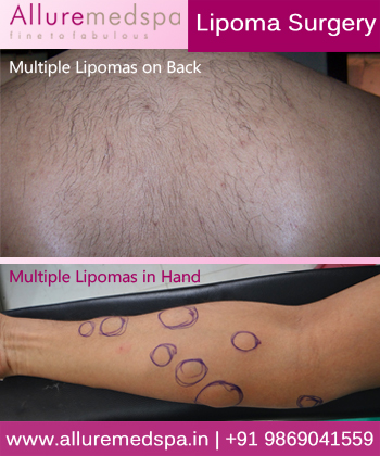 Multiple Lipomas Removal Surgery in Mumbai, India