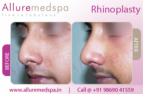 Nose Plastic Surgery Before and After Photos in Mumbai, India