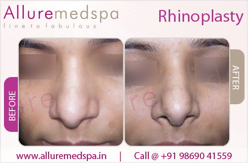 Rhinoplasty Before and After Images in Mumbai, India