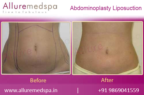 Abdominoplasty Liposuction Before and After Pictures in Mumbai, India