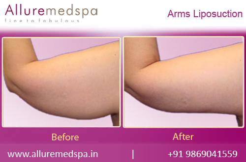 Arm Liposuction Before and After Photos in Mumbai, India