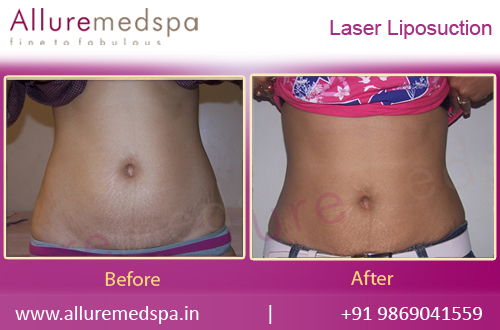 Laser Liposuction Before and After Images in Mumbai, India