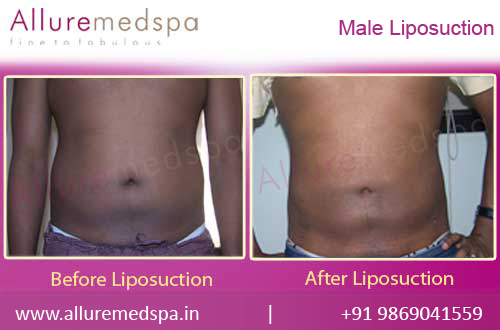 Male Liposuction Before and After Photos in Mumbai, India