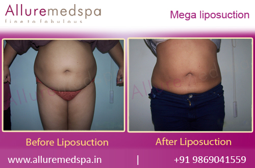 Mega Liposuction Before and After Pictures in Mumbai, India