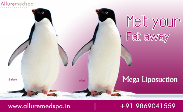 Mega liposuction Surgery | Mega Volume Liposuction Surgery | large Volume Liposuction in Mumbai, India