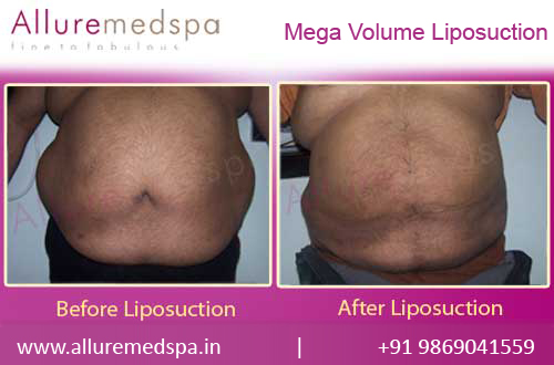 Mega Volume Liposuction Before and After Result in Mumbai, India