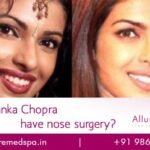 Priyanka Chopra Nose Surgery Before and after Photos