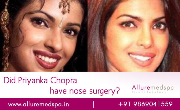 Priyanka Chopra Nose Surgery Before and after Photos