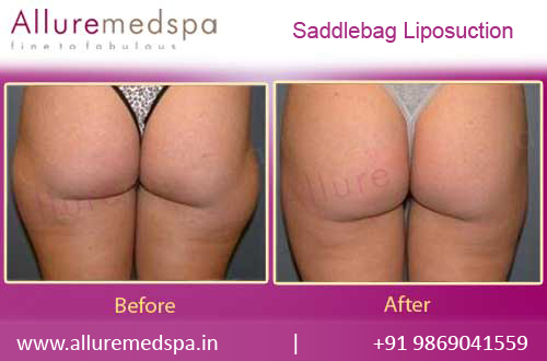Saddlebag Liposuction Before & After Ph otosin Mumbai, India