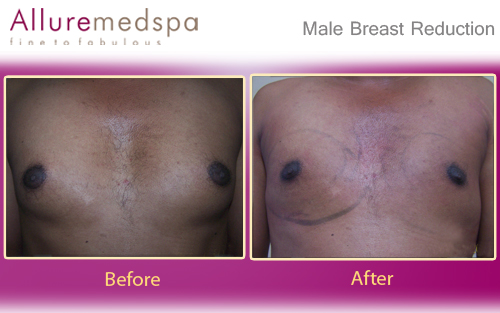 Male Breast Reduction Surgery Before and After Pictures in Mumbai, India