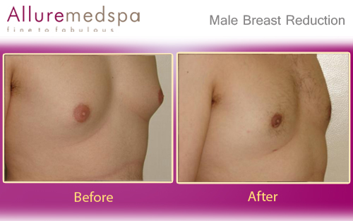 Male Breast Reduction Before after Photos | Gynecomastia Before after Pictures in Mumbai, India