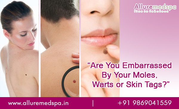 Mole, Wart & Tags Removal Treatment in Andheri, Mumbai, India