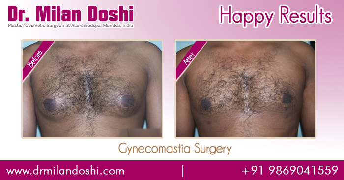 Gynecomastia Surgery Before and After Images in Mumbai, India