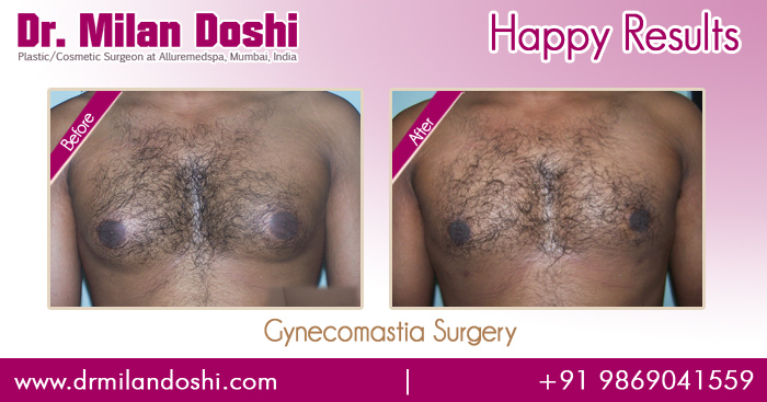 gynecomastia-surgery-before-after