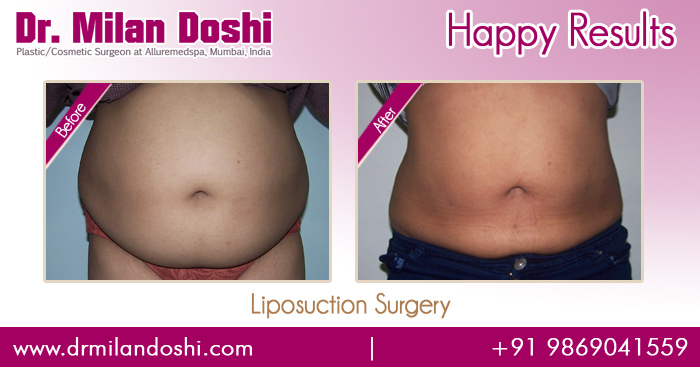 Liposuction Surgery Before and After Result in Mumbai, India