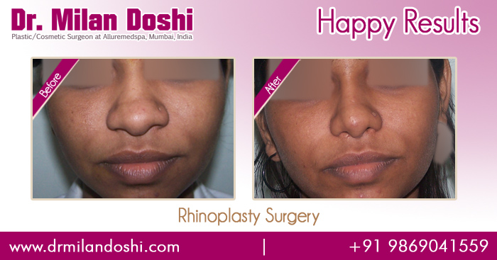 Rhinoplasty Surgery Before and After Images in Mumbai, India