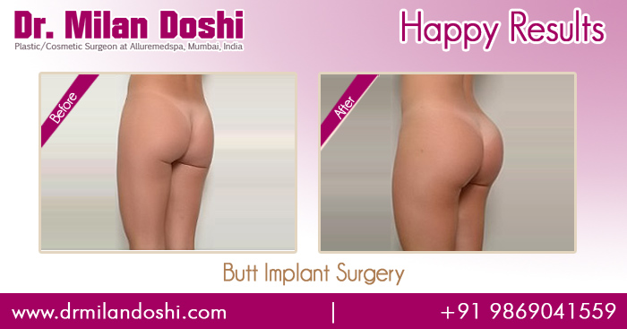 Buttock Implants Before and After Photos