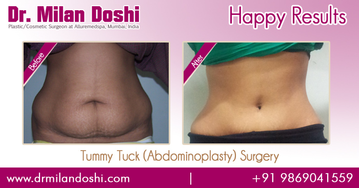 Tummy Tuck Before After Results - Dr. Milan Doshi