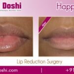 Lip Reduction Surgery in Mumbai, India