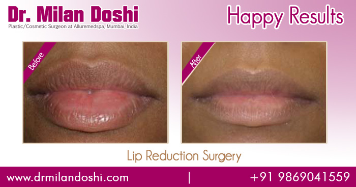 Lip Reduction Surgery Before and After Images