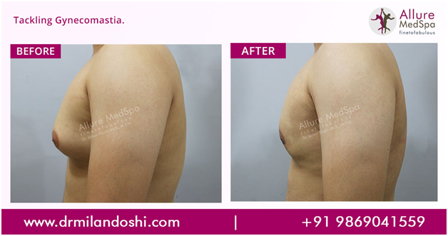 Dr Milan Doshi - Gynecomastia Before and After