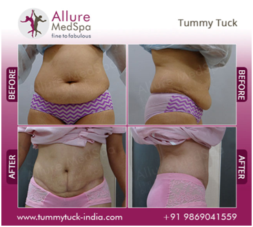 Tummy Tuck Surgery Before and After Images