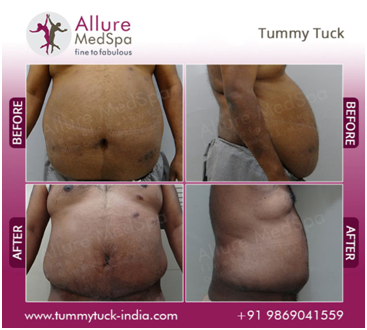 Abdominoplasty Surgery Before and After Images