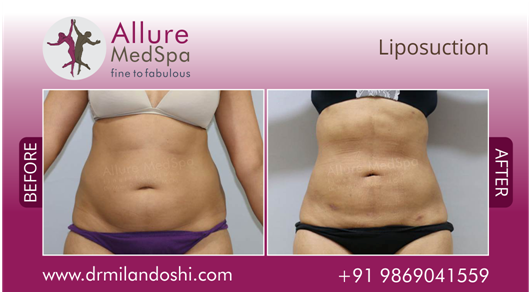 Liposuction Surgery Before and After Photo