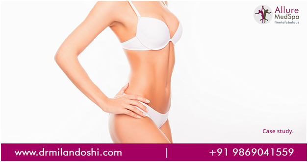 Dr Milan Doshi - Liposuction Case Study