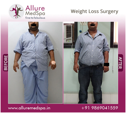 Weight loss surgery before and after image