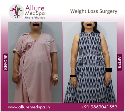 Bariatric Surgery before and after image