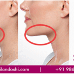 Chin Liposuction in Mumbai, India