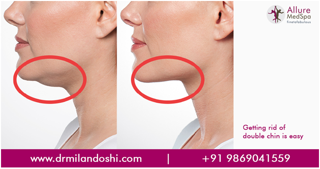 Chin Liposuction in Mumbai, India