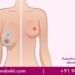 Breast Reduction Surgery in Mumbai, India