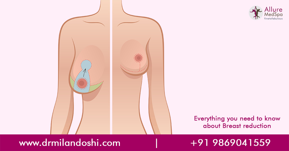 Breast Reduction Surgery in Mumbai, India