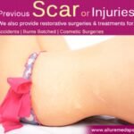 scar revision surgery