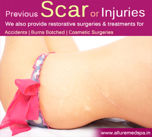 Scar Revision Surgery in Mumbai, India