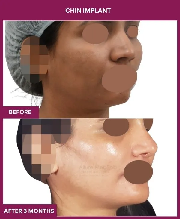 Chin Augmentation Before & After: How to Read Results (Realistic Expectations) 31 11 Chin Implant (3)_31
