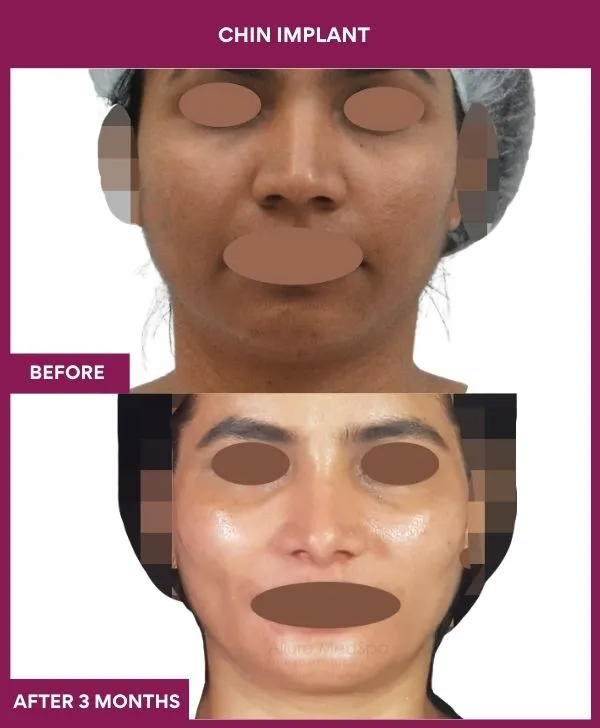 Chin Augmentation Before & After: How to Read Results (Realistic Expectations) 32 11 Chin Implant (4)_31
