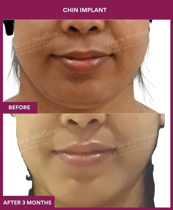 Chin Augmentation Before & After: How to Read Results (Realistic Expectations) 35 13 Chin Implant (4)_36