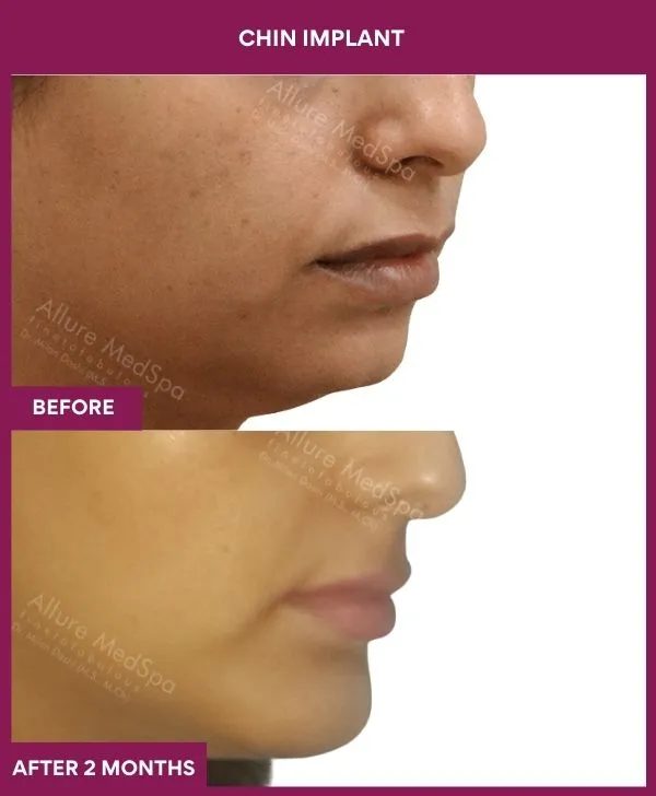 Chin Augmentation Before & After: How to Read Results (Realistic Expectations) 37 14 Chin Implant (3)_39_