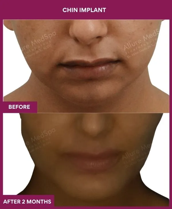 Chin Augmentation Before & After: How to Read Results (Realistic Expectations) 38 14 Chin Implant (4)_39_